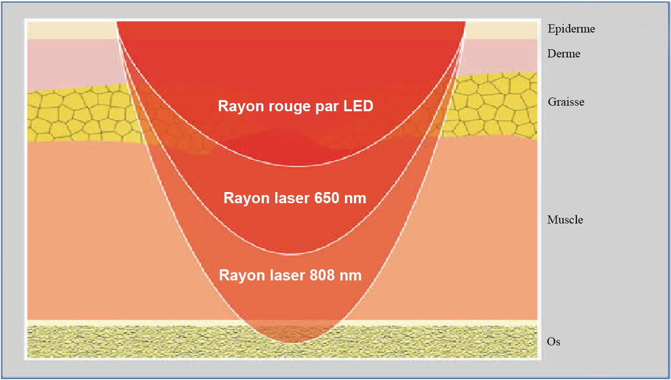 Laser froid